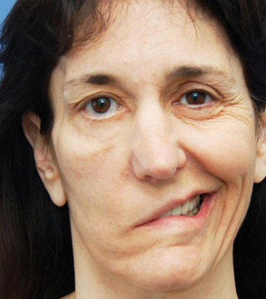 BELL'S AND FACIAL PALSY image